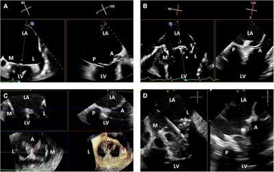 3-dimensional intracardiac echocardiography for structural heart interventions